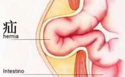 什么是腹股沟疝？哪些人容易得这种病,腹股沟在哪个位置图片图解