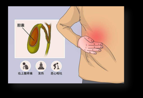 胆囊炎哪里痛（胆囊炎哪里痛疼痛位置）-图2