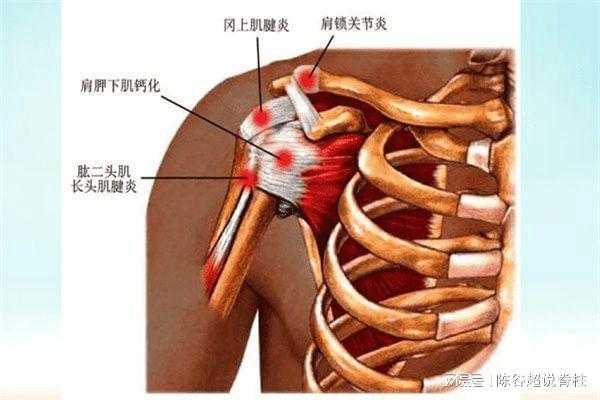 肩周炎哪里疼（肩周炎的症状有哪些呢）-图1