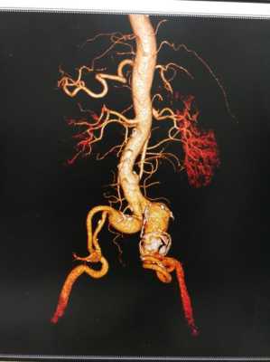 腹主动脉腹壁血栓怎样治疗,腹主动脉在哪里分为左右髂总动脉-图2