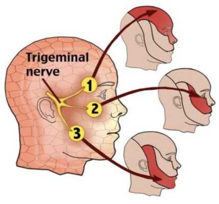 三叉神经痛有什么症状,三叉神经疼都是哪里疼-图3