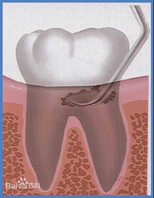 洗牙和牙周刮治一样吗，有哪些区别,洗牙去哪里洗比较好-图2