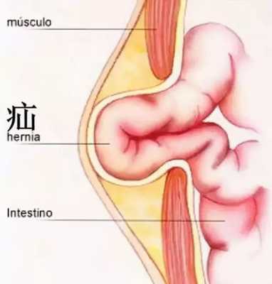 什么是腹股沟疝？哪些人容易得这种病,腹股沟在哪个位置图片图解-图1