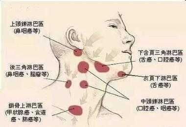 颈部淋巴是什么原因导致的,脖子淋巴结在哪里部位图片-图1