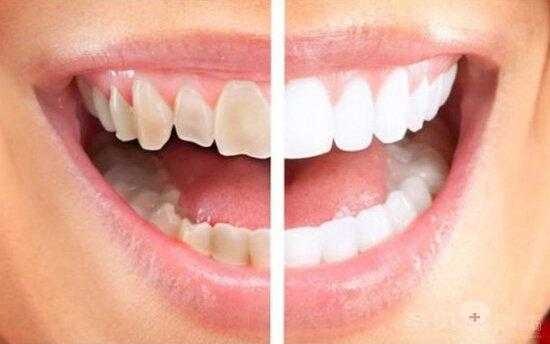 什么是美容牙,牙齿美容去哪里比较好-图1