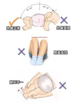 新生儿两腿不能平铺是怎么回事？新生儿髋关节发育不良对宝宝有什么影响,髋关节在哪里图片髋关节-图2
