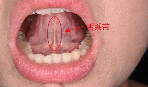 舌根部有舌苔,舌根部位在哪-图2